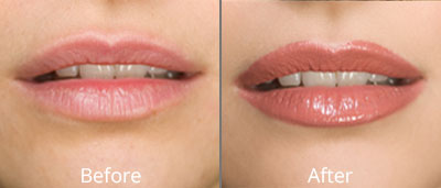 Permanent Makeup Before and Afters in Darien CT at Versailles Medical Spa